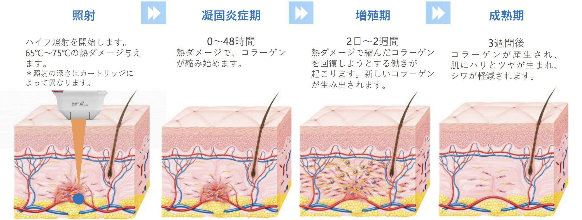 他の治療機器との違い